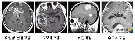 악성 뇌종양