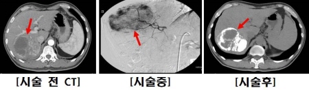 경동맥화학색전술 전후에 간암 부위 비교