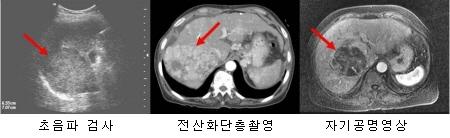 간암의 진단방법