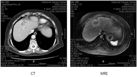 간내 담관암 CT, MRI