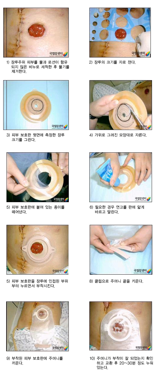 장루 주머니의 교환 방법