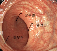 직장 휴스톤판의 내시경적 소견