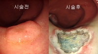 조기직장암의 내시경적 절제술