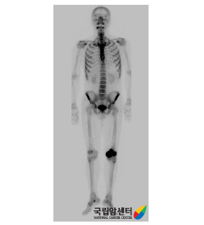 왼쪽 대퇴골 하단부 골육종의 bone scan